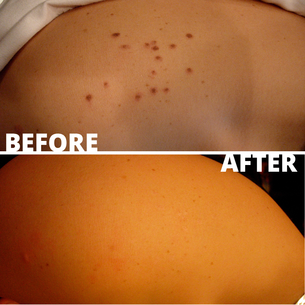 Cherry angiomas before and after cryotherapy removal